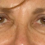 Eyelid Surgery Before & After Patient #7086