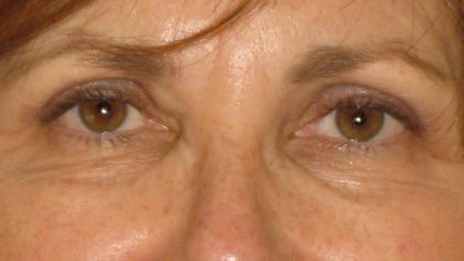Eyelid Surgery Before & After Patient #7086