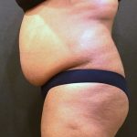 Liposuction Before & After Patient #7274