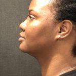 Kybella Before & After Patient #7271