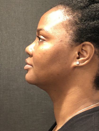 Kybella Before & After Patient #7271