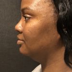 Kybella Before & After Patient #7271