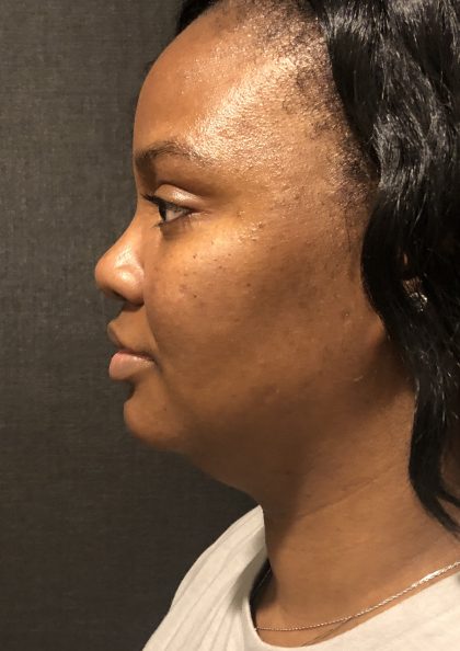 Kybella Before & After Patient #7271