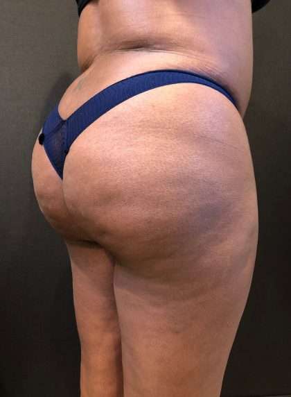 Fat Transfer to Butt Before & After Patient #7580