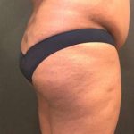 Fat Transfer to Butt Before & After Patient #7580