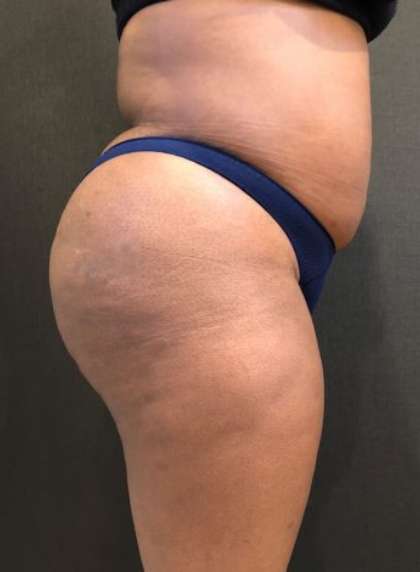 Fat Transfer to Butt Before & After Patient #7580