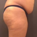 Fat Transfer to Butt Before & After Patient #7580