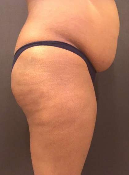 Patient #7580 Fat Transfer to Butt Before and After Photos Marin