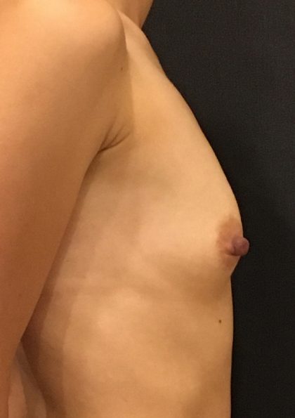 Breast Augmentation Before & After Patient #7674