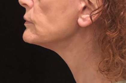 Necklift Before & After Patient #7741