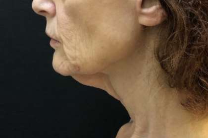 Necklift Before & After Patient #7741