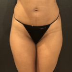 Liposuction Before & After Patient #7843