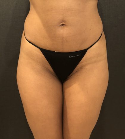 Liposuction Before & After Patient #7843