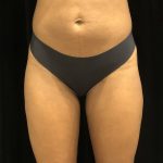 Liposuction Before & After Patient #7843