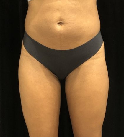 Liposuction Before & After Patient #7843