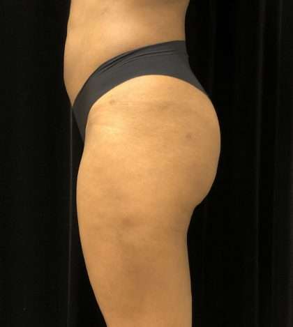 Fat Transfer to Butt Before & After Patient #7867