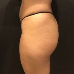 Fat Transfer to Butt Before & After Patient #7867