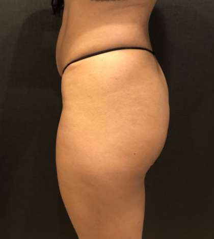 Fat Transfer to Butt Before & After Patient #7867