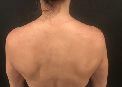 Laser Skin Resurfacing Before & After Patient #7864