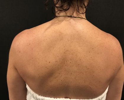 Laser Skin Resurfacing Before & After Patient #7864