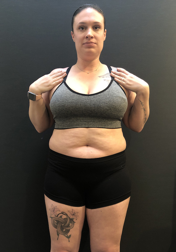 Gastric Balloon Before & After Patient #7951