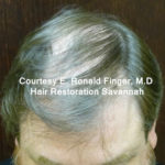 Hair Restoration with Neograft Before & After Patient #8456