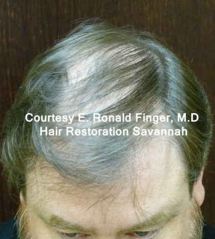 Hair Restoration with Neograft Before & After Patient #8456