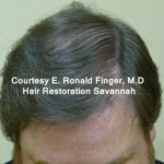 Hair Restoration with Neograft Before & After Patient #8456