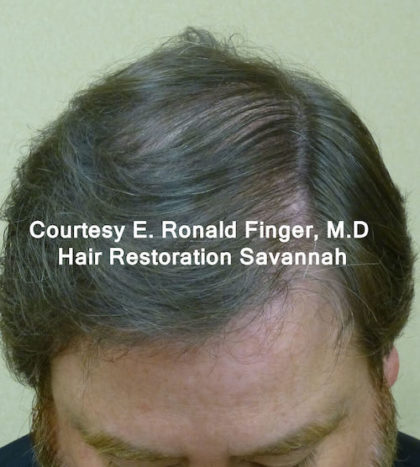 Hair Restoration with Neograft Before & After Patient #8456