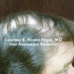 Hair Restoration with Neograft Before & After Patient #8456