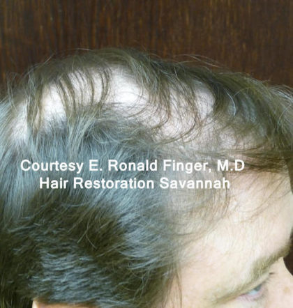 Hair Restoration with Neograft Before & After Patient #8456