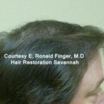 Hair Restoration with Neograft Before & After Patient #8456