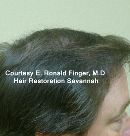 Hair Restoration with Neograft Before & After Patient #8456