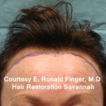 Hair Restoration with Neograft Before & After Patient #8461