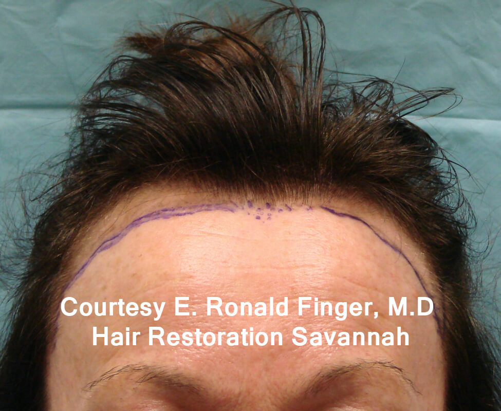 Hair Restoration with Neograft Before & After Patient #8461