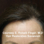 Hair Restoration with Neograft Before & After Patient #8461