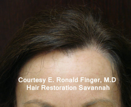 Hair Restoration with Neograft Before & After Patient #8461