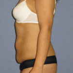 Tummy Tuck Before & After Patient #8656