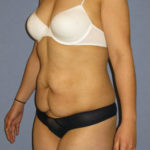 Tummy Tuck Before & After Patient #8656