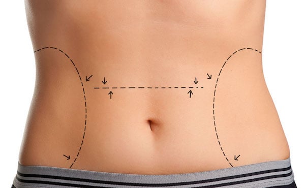 tummy tuck procedure