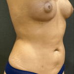 Fat Transfer to Breast Before & After Patient #9416