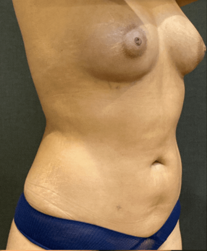 Fat Transfer to Breast Before & After Patient #9416