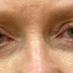 Eyelid Surgery Before & After Patient #9431