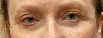 Eyelid Surgery Before & After Patient #9431