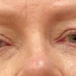 Eyelid Surgery Before & After Patient #9431
