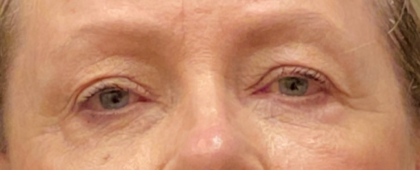 Eyelid Surgery Before & After Patient #9431
