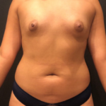 Liposuction Before & After Patient #9419