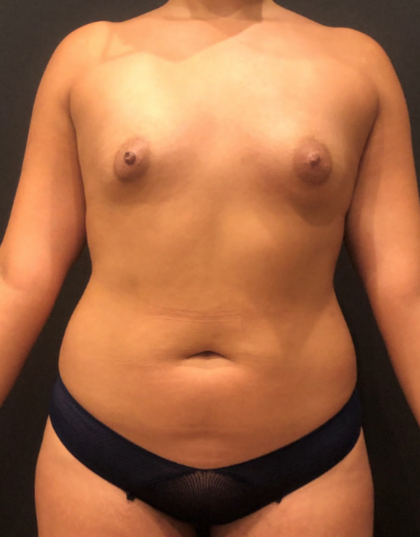 Liposuction Before & After Patient #9419