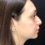 Rhinoplasty Before & After Patient #9758