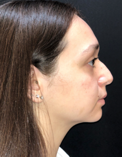 Rhinoplasty Before & After Patient #9758